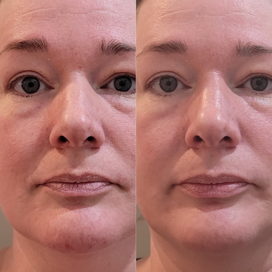 Side-by-side front-facing skin comparison showing overall tone and texture