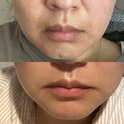 Before-and-after lower-face comparison showing skin around the mouth and chin
