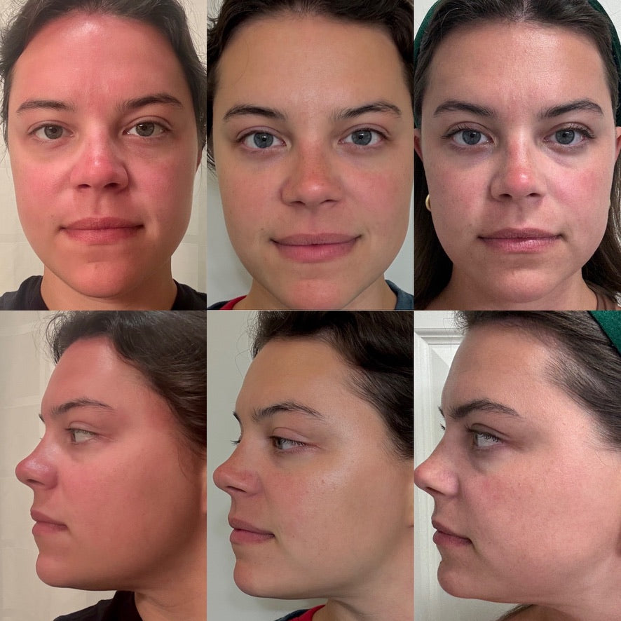Six-view front and profile facial comparison showing changes in redness and skin tone