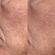 Side-by-side close-up cheek comparison showing fine lines and skin texture