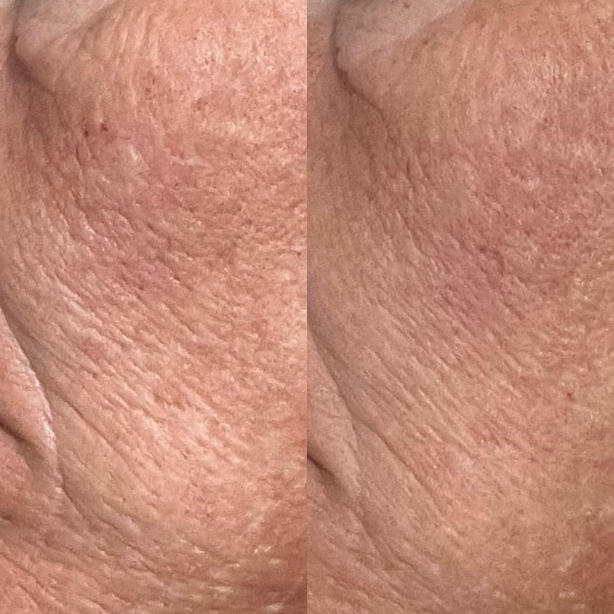 Side-by-side close-up cheek comparison showing fine lines and skin texture
