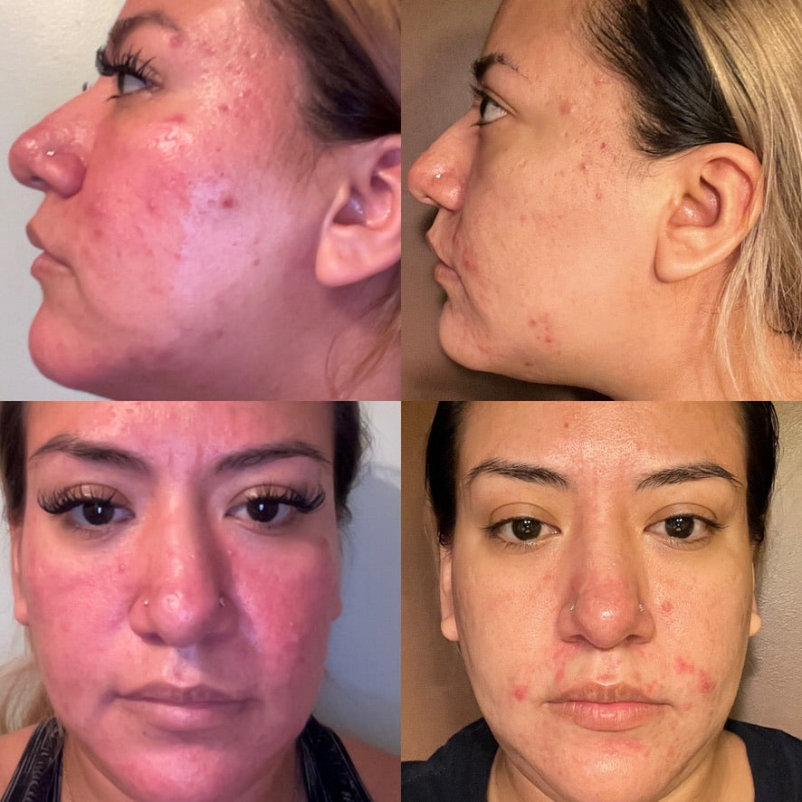 Four-view front and profile facial comparison showing redness and blemish-prone areas