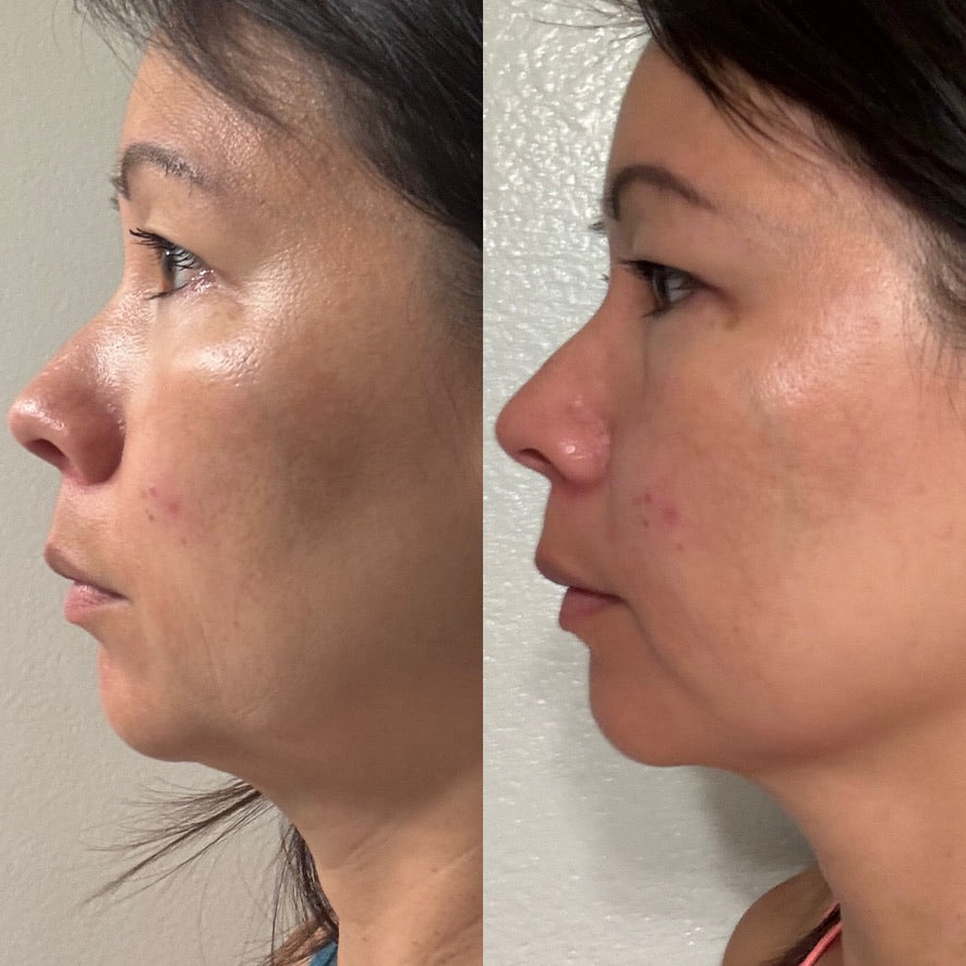 Side-by-side profile facial skin comparison showing cheek texture and radiance