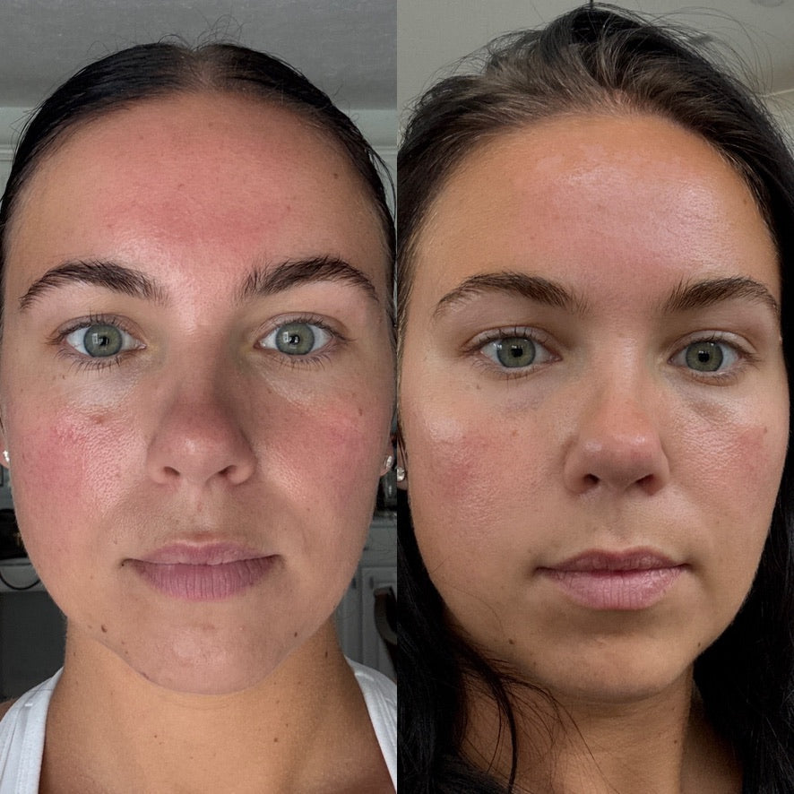 Side-by-side full-face comparison showing redness and more even-looking skin tone