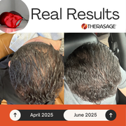 Real result of Therasage TheraCap