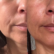 Side-by-side lower-face skin comparison showing the cheek, mouth and chin area