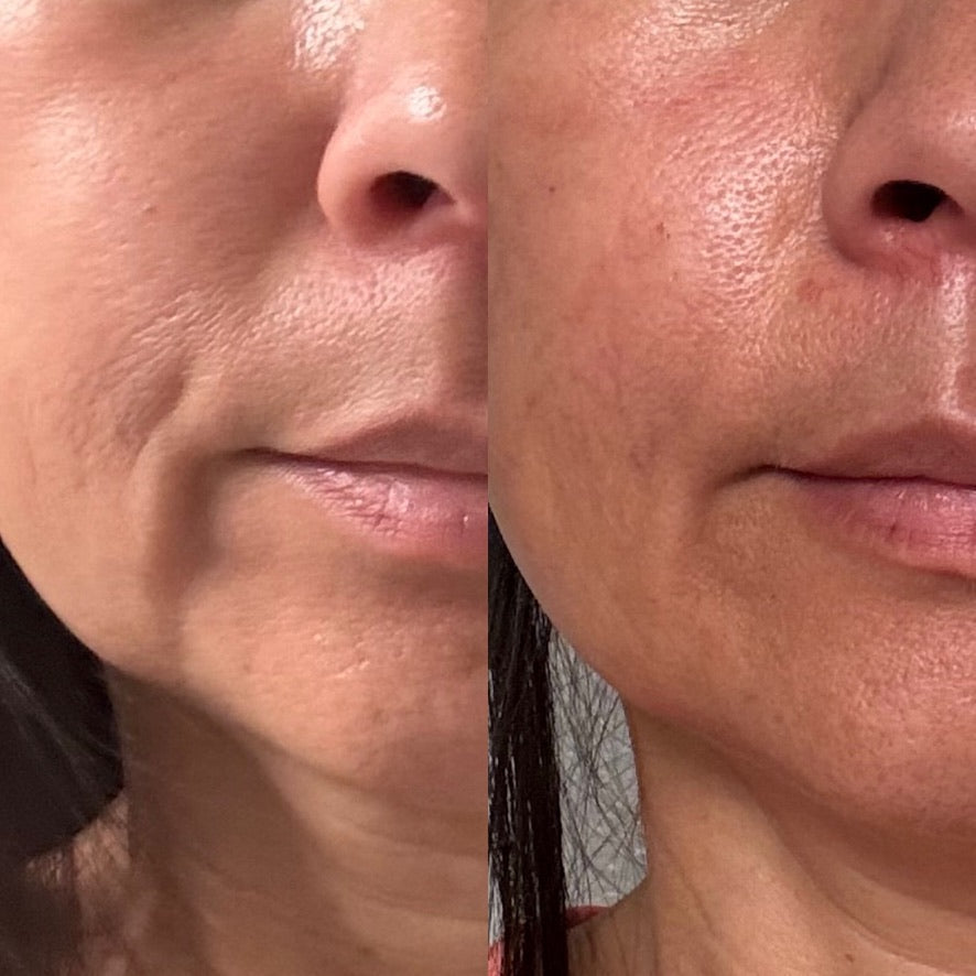 Side-by-side lower-face skin comparison showing the cheek, mouth and chin area