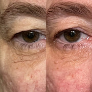 Side-by-side close-up comparison of skin around the eye and upper cheek