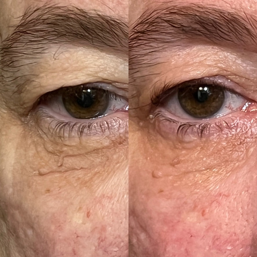 Side-by-side close-up comparison of skin around the eye and upper cheek
