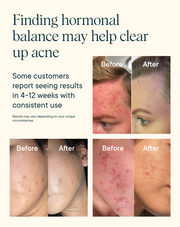 Finding hormonal balance may help clear up acne - Ora Organic Hormonious: Hormonal Balance & Support Capsules